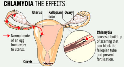 chlamydia-can-cause-difficulty-getting-pregnant-if-untreated