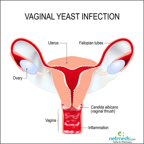  Čuvajte se vaginalne kandide jer može dovesti do Alchajmerove bolesti